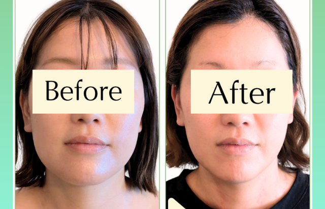 【リピート率No.１】食いしばり・不眠改善トリムヘッド